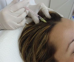 Мезотерапия для лечения выпадения волос