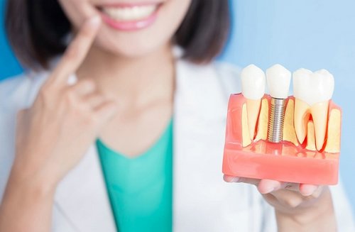 Идеальная улыбка: всё о процедуре имплантации зубов
